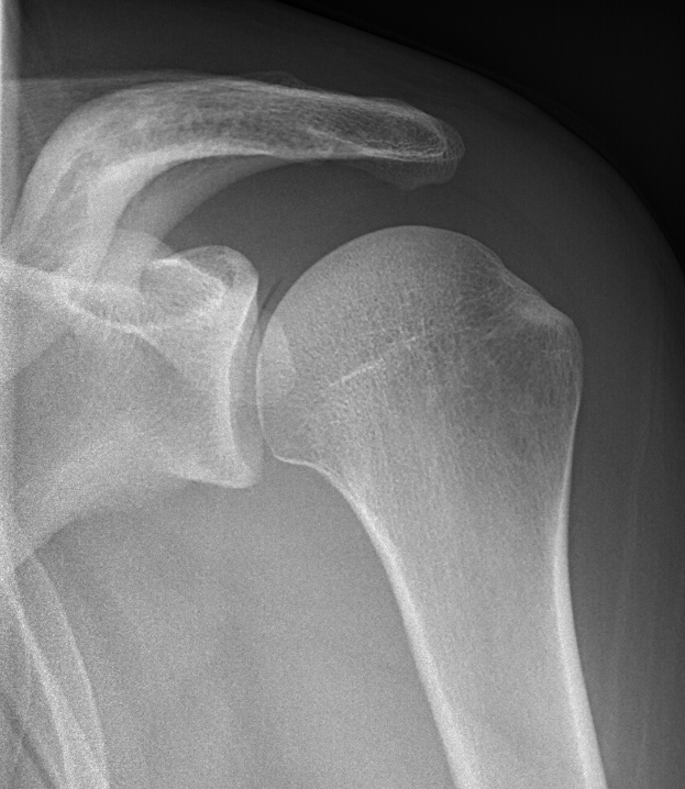 Ein Röntgenbild, das die Knochen und Bänder eines Schultergelenks zeigt.