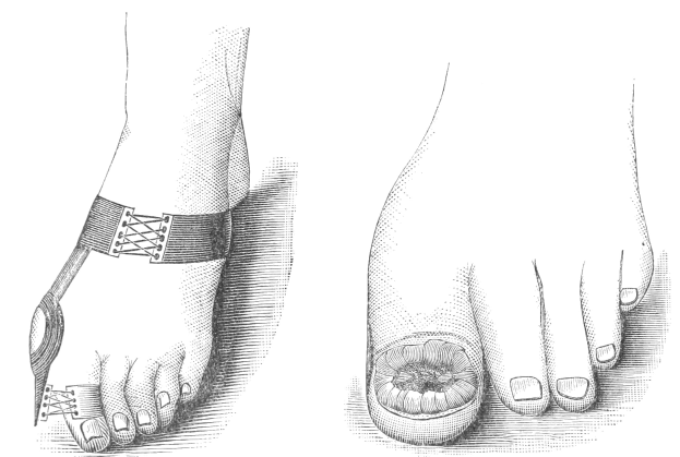 Schwarze und weiße Zeichnung von zwei Füßen, einer mit einem Verband und der andere mit einer Fraktur, mit Text, der die Behandlung angibt.