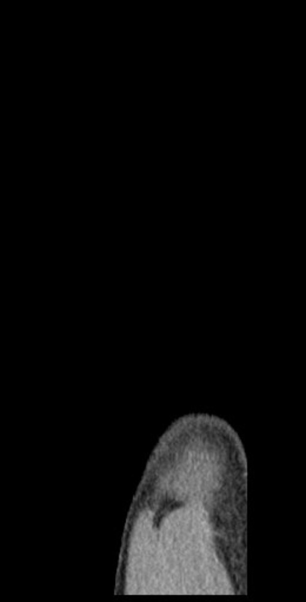 Schwarze und weiße MRI-Aufnahme eines Mannes, die einen detaillierten Blick auf das Gehirn zeigt.